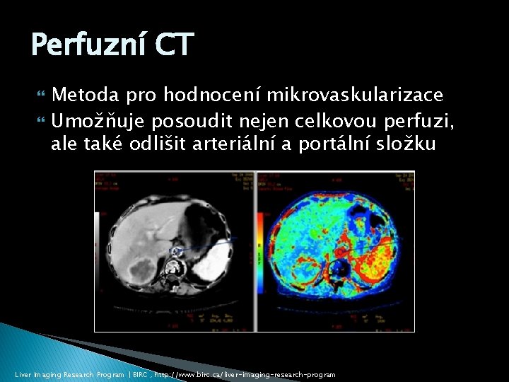 Perfuzní CT Metoda pro hodnocení mikrovaskularizace Umožňuje posoudit nejen celkovou perfuzi, ale také odlišit