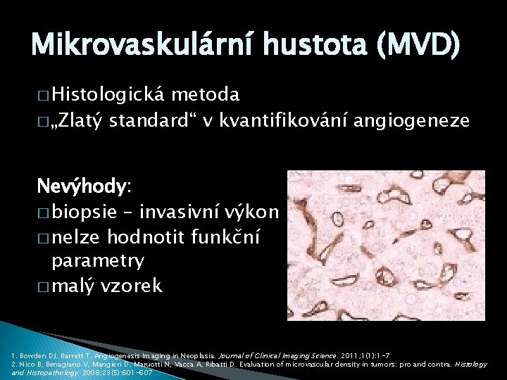 Mikrovaskulární hustota (MVD) � Histologická metoda � „Zlatý standard“ v kvantifikování angiogeneze Nevýhody: �