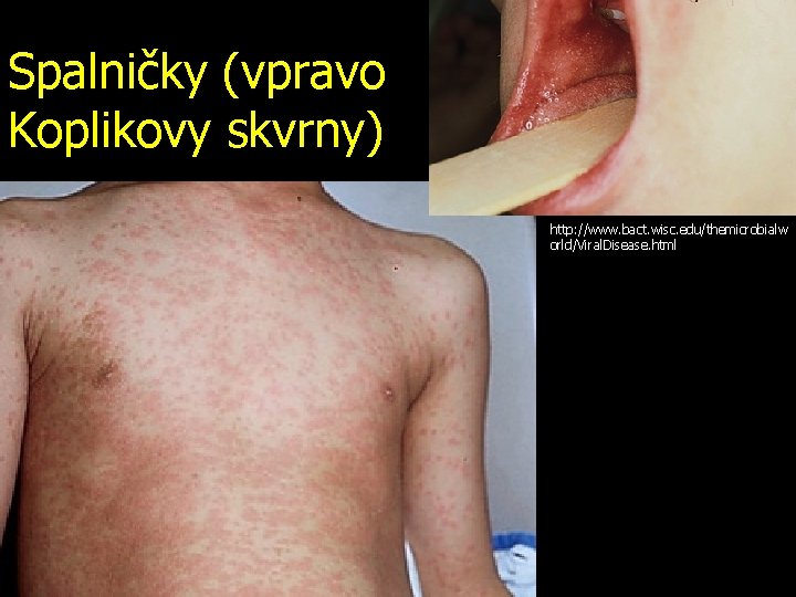 Spalničky (vpravo Koplikovy skvrny) http: //www. bact. wisc. edu/themicrobialw orld/Viral. Disease. html 