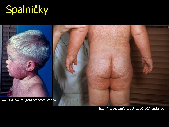 Spalničky www. lib. uiowa. edu/hardin/md/measles. html. http: //z. about. com/d/pediatrics/1/0/e/2/measles. jpg 