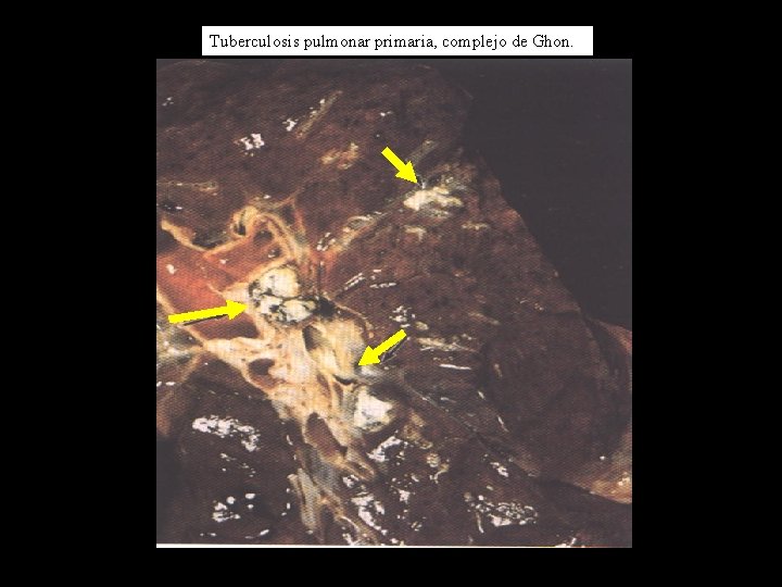 Tuberculosis pulmonar primaria, complejo de Ghon. 