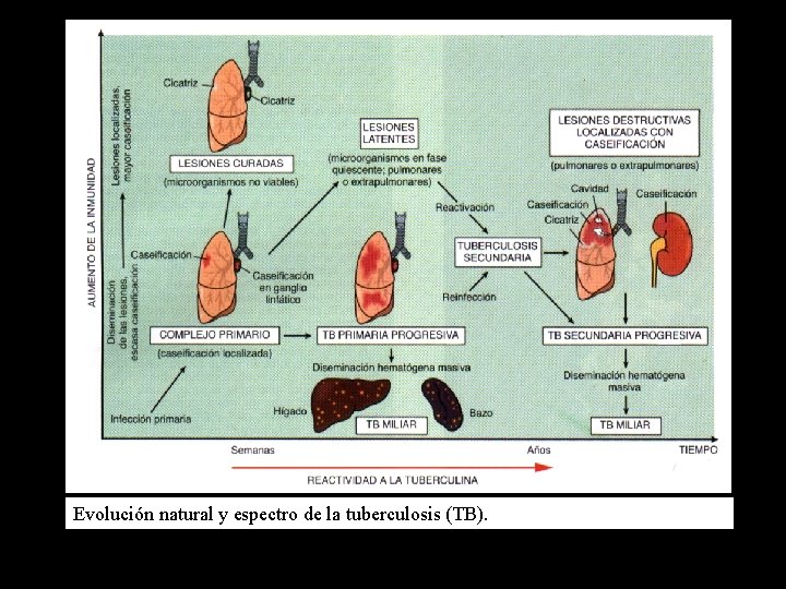 Evolución natural y espectro de la tuberculosis (TB). 