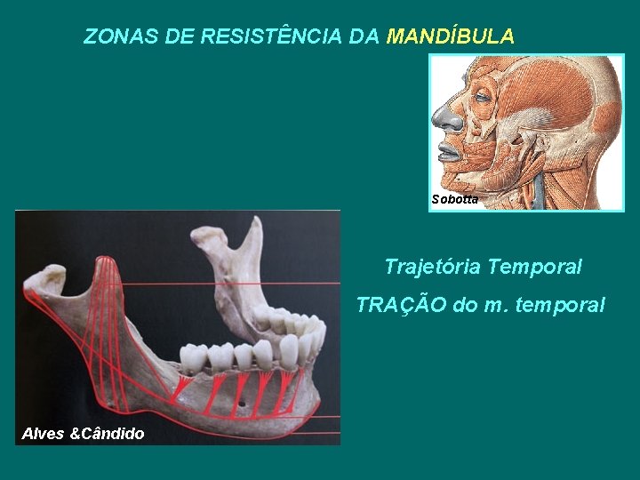 ZONAS DE RESISTÊNCIA DA MANDÍBULA Sobotta Trajetória Temporal TRAÇÃO do m. temporal Alves &Cândido