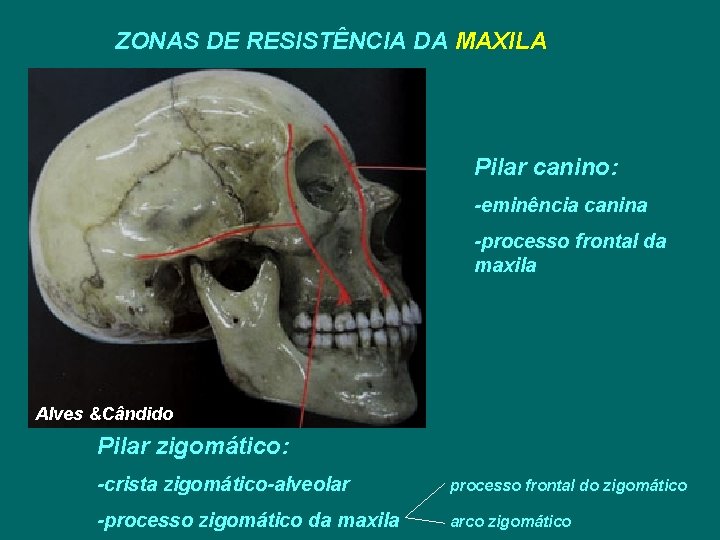 ZONAS DE RESISTÊNCIA DA MAXILA Pilar canino: -eminência canina -processo frontal da maxila Alves