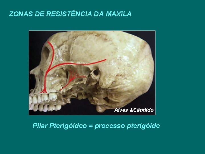 ZONAS DE RESISTÊNCIA DA MAXILA Alves &Cândido Pilar Pterigóideo = processo pterigóide 