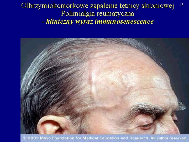 Olbrzymiokomórkowe zapalenie tętnicy skroniowej Polimialgia reumatyczna - kliniczny wyraz immunosenescence 16 