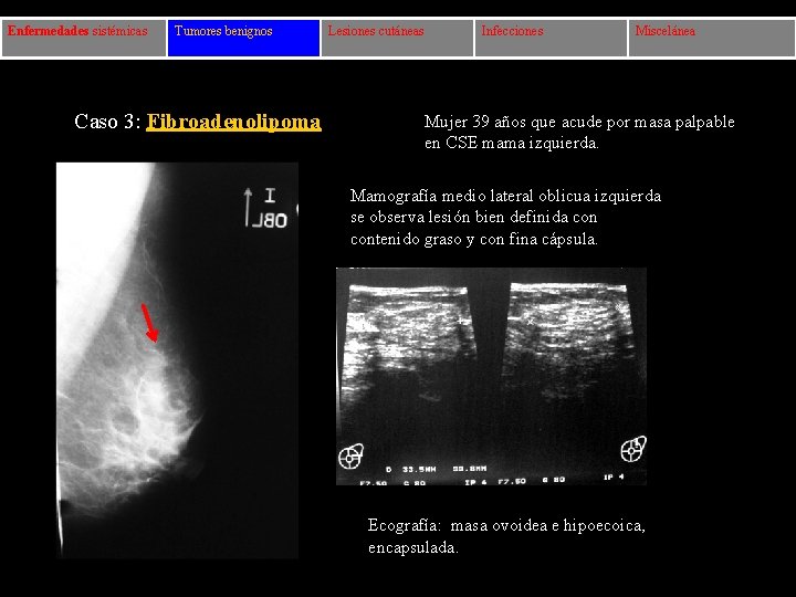 Enfermedades sistémicas Tumores benignos Caso 3: Fibroadenolipoma Lesiones cutáneas Infecciones Miscelánea Mujer 39 años