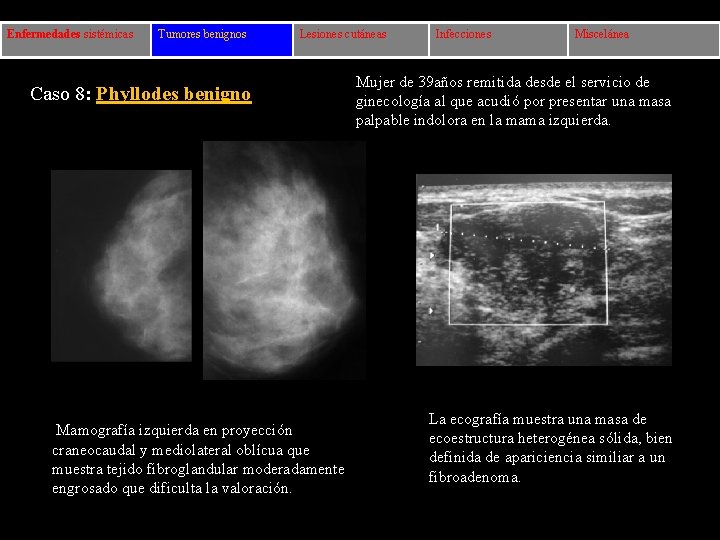 Enfermedades sistémicas Tumores benignos Lesiones cutáneas Caso 8: Phyllodes benigno Mamografía izquierda en proyección