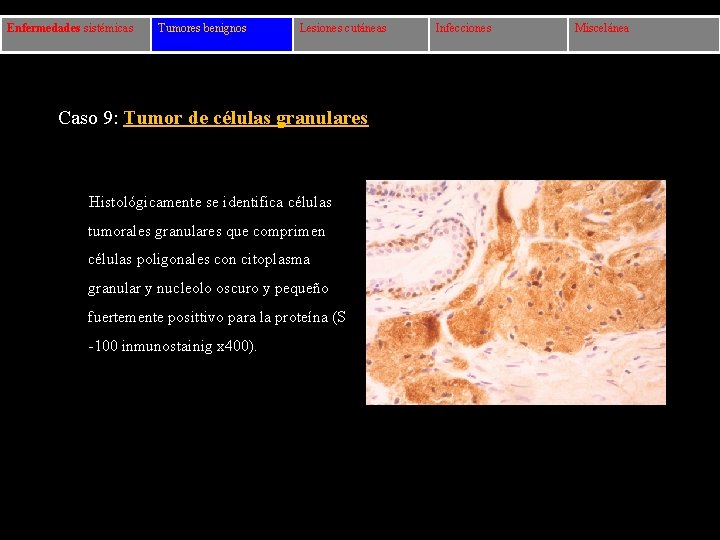 Enfermedades sistémicas Tumores benignos Lesiones cutáneas Caso 9: Tumor de células granulares Histológicamente se