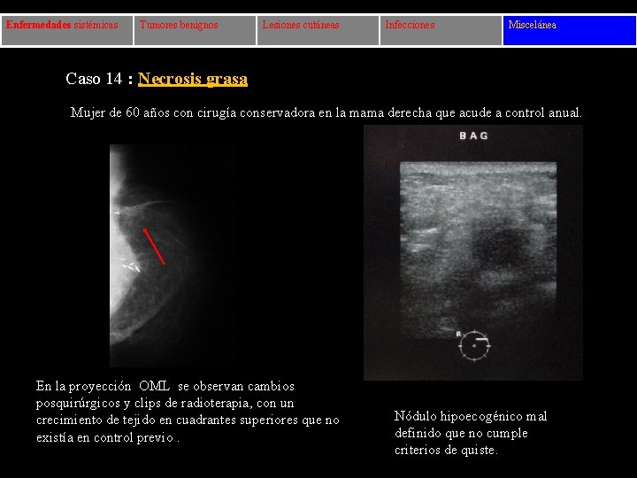 Enfermedades sistémicas Tumores benignos Lesiones cutáneas Infecciones Miscelánea Caso 14 : Necrosis grasa Mujer