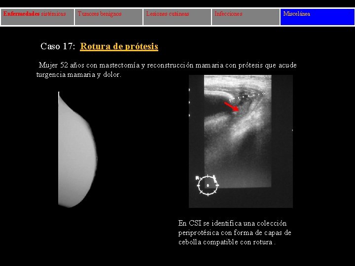 Enfermedades sistémicas Tumores benignos Lesiones cutáneas Infecciones Miscelánea Caso 17: Rotura de prótesis Mujer