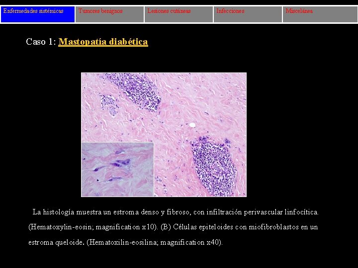 Enfermedades sistémicas Tumores benignos Lesiones cutáneas Infecciones Miscelánea Caso 1: Mastopatía diabética La histología