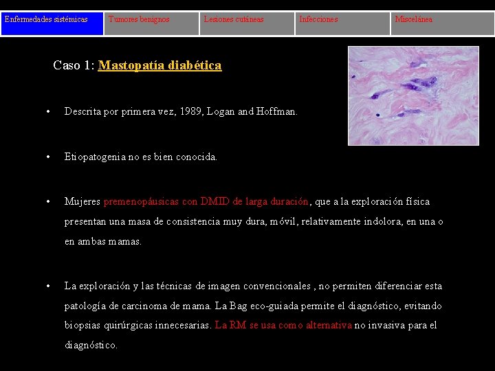 Enfermedades sistémicas Tumores benignos Lesiones cutáneas Infecciones Miscelánea Caso 1: Mastopatía diabética • Descrita