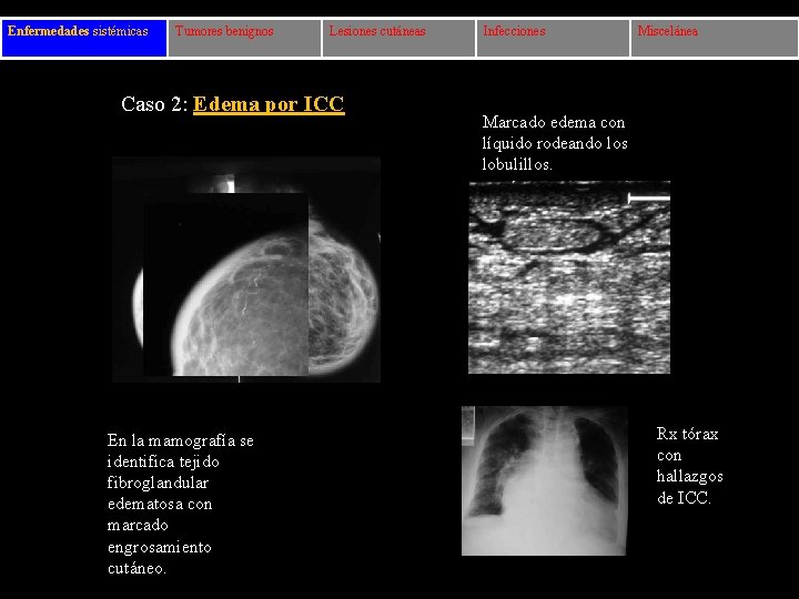 Enfermedades sistémicas Tumores benignos Lesiones cutáneas Caso 2: Edema por ICC En la mamografía