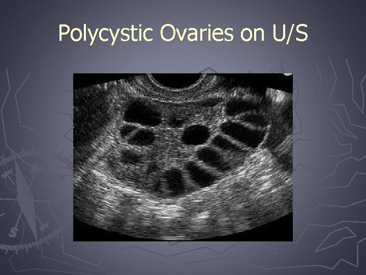Polycystic Ovaries on U/S 