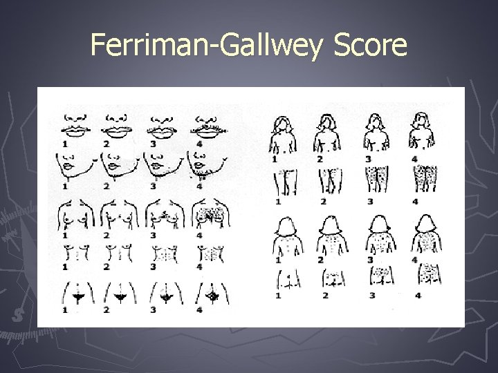 Ferriman-Gallwey Score 
