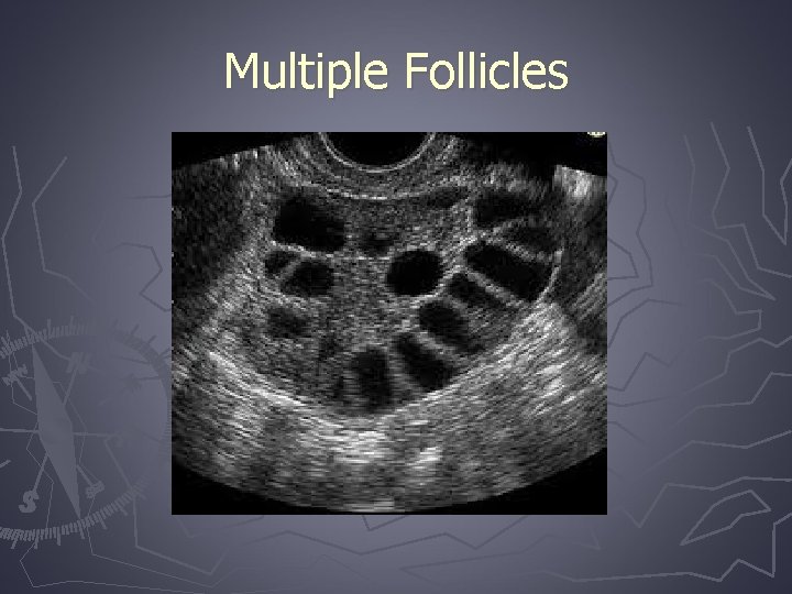 Multiple Follicles 