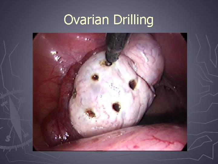 Ovarian Drilling 