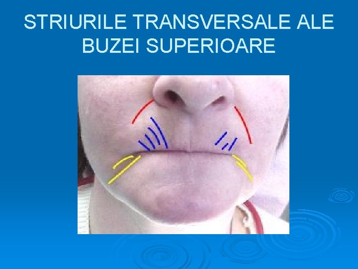 STRIURILE TRANSVERSALE BUZEI SUPERIOARE 