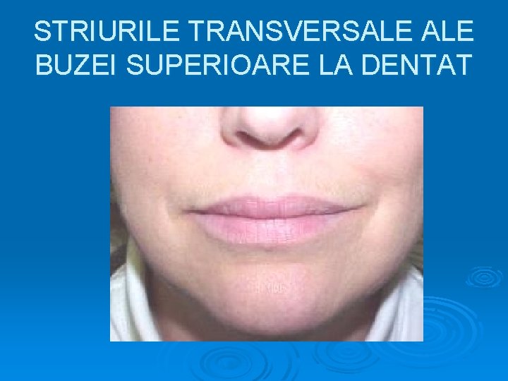 STRIURILE TRANSVERSALE BUZEI SUPERIOARE LA DENTAT 