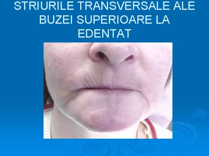 STRIURILE TRANSVERSALE BUZEI SUPERIOARE LA EDENTAT 