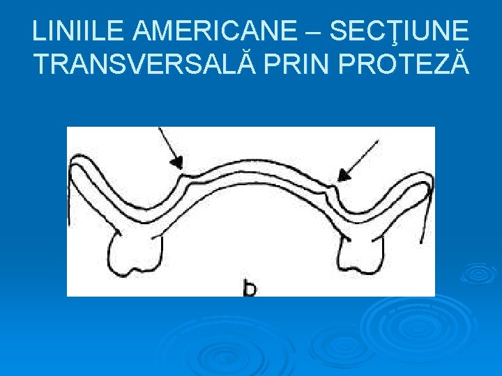 LINIILE AMERICANE – SECŢIUNE TRANSVERSALĂ PRIN PROTEZĂ 