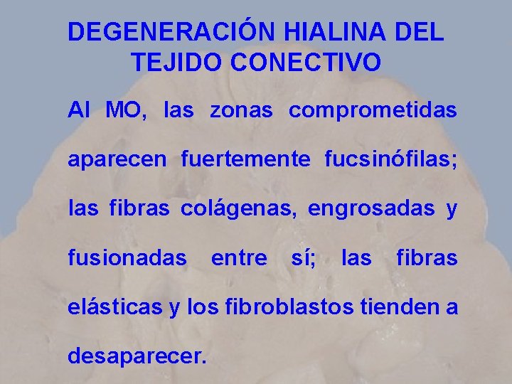 DEGENERACIÓN HIALINA DEL TEJIDO CONECTIVO Al MO, las zonas comprometidas aparecen fuertemente fucsinófilas; las