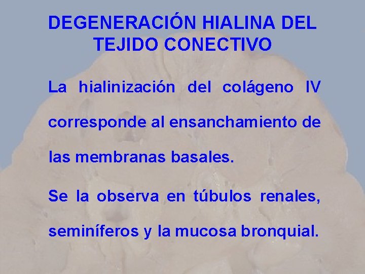 DEGENERACIÓN HIALINA DEL TEJIDO CONECTIVO La hialinización del colágeno IV corresponde al ensanchamiento de