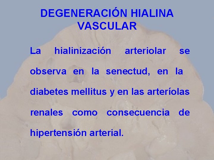 DEGENERACIÓN HIALINA VASCULAR La hialinización arteriolar se observa en la senectud, en la diabetes