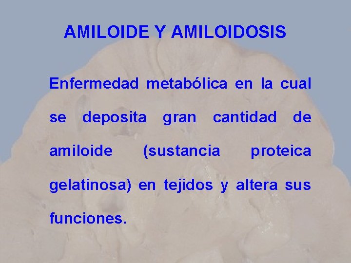 AMILOIDE Y AMILOIDOSIS Enfermedad metabólica en la cual se deposita amiloide gran cantidad (sustancia