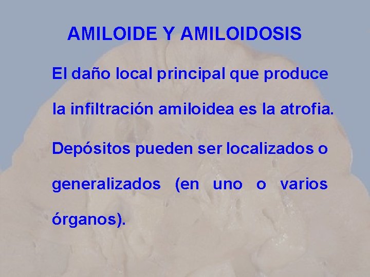 AMILOIDE Y AMILOIDOSIS El daño local principal que produce la infiltración amiloidea es la