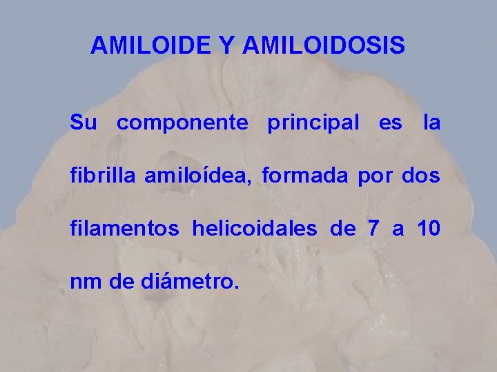 AMILOIDE Y AMILOIDOSIS Su componente principal es la fibrilla amiloídea, formada por dos filamentos