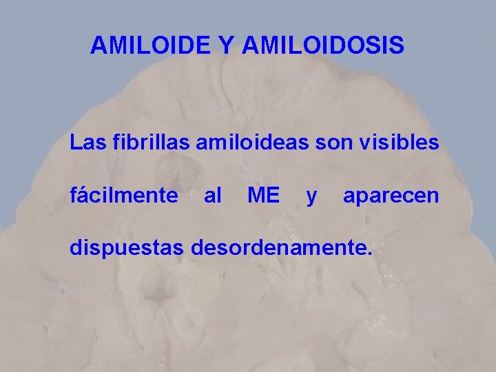 AMILOIDE Y AMILOIDOSIS Las fibrillas amiloideas son visibles fácilmente al ME y aparecen dispuestas