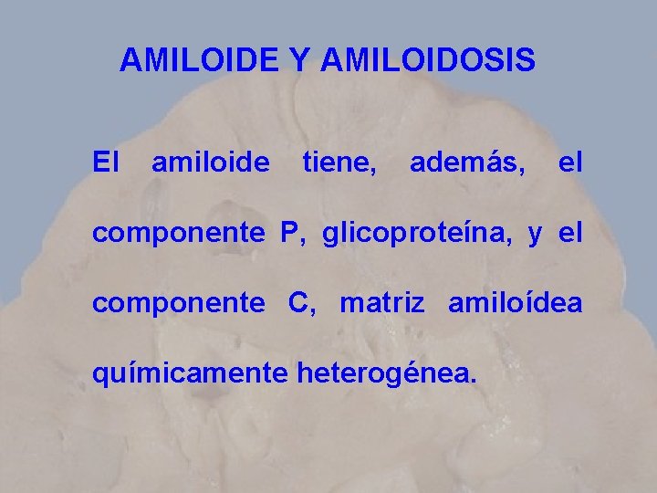 AMILOIDE Y AMILOIDOSIS El amiloide tiene, además, el componente P, glicoproteína, y el componente