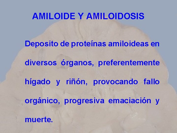 AMILOIDE Y AMILOIDOSIS Deposito de proteínas amiloideas en diversos órganos, preferentemente hígado y riñón,