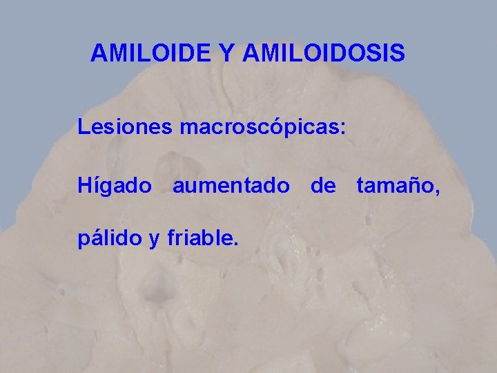 AMILOIDE Y AMILOIDOSIS Lesiones macroscópicas: Hígado aumentado de tamaño, pálido y friable. 