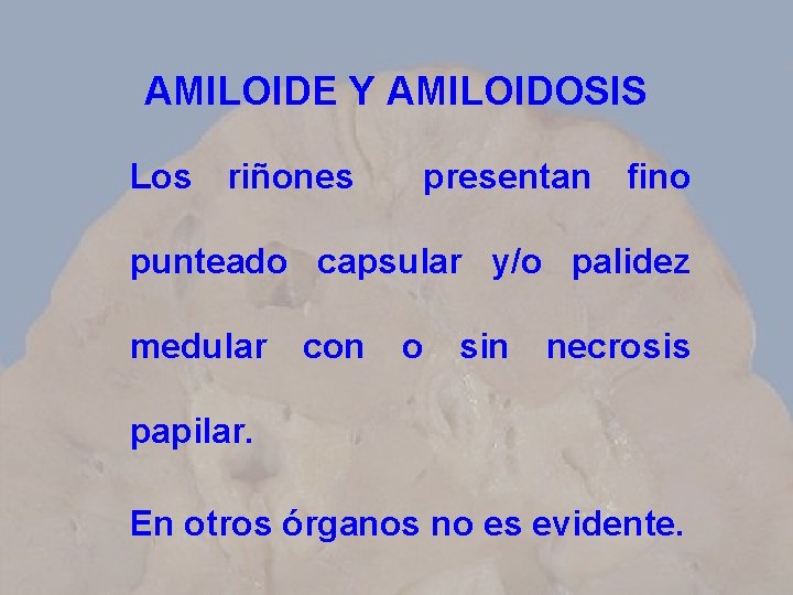 AMILOIDE Y AMILOIDOSIS Los riñones presentan fino punteado capsular y/o palidez medular con o