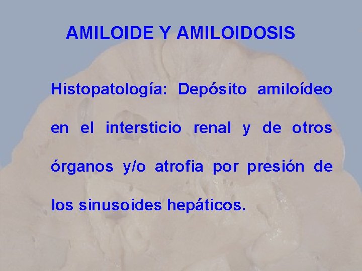 AMILOIDE Y AMILOIDOSIS Histopatología: Depósito amiloídeo en el intersticio renal y de otros órganos