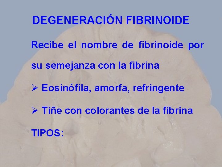 DEGENERACIÓN FIBRINOIDE Recibe el nombre de fibrinoide por su semejanza con la fibrina Ø