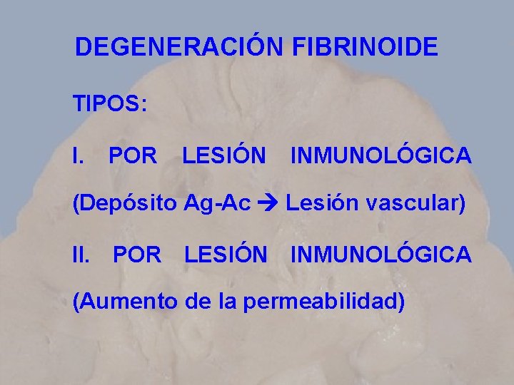 DEGENERACIÓN FIBRINOIDE TIPOS: I. POR LESIÓN INMUNOLÓGICA (Depósito Ag-Ac Lesión vascular) II. POR LESIÓN