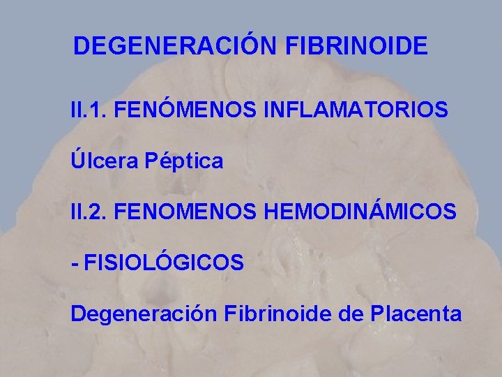 DEGENERACIÓN FIBRINOIDE II. 1. FENÓMENOS INFLAMATORIOS Úlcera Péptica II. 2. FENOMENOS HEMODINÁMICOS - FISIOLÓGICOS