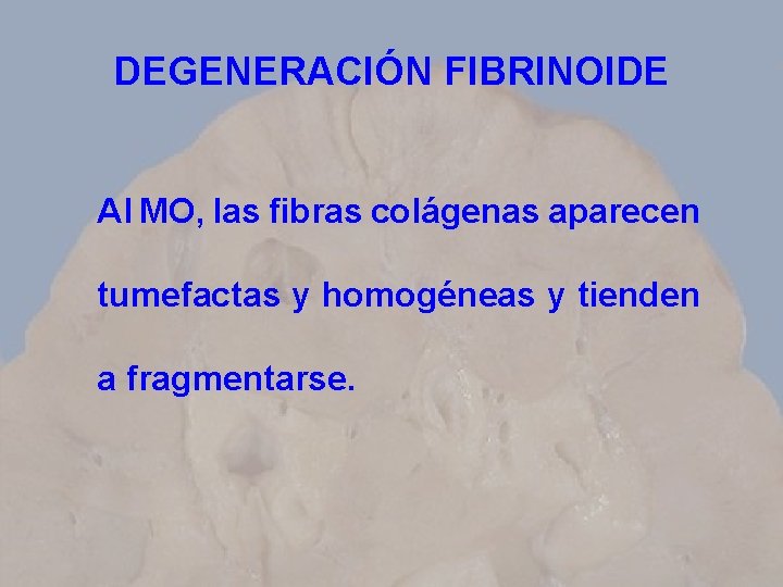 DEGENERACIÓN FIBRINOIDE Al MO, las fibras colágenas aparecen tumefactas y homogéneas y tienden a