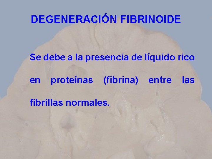 DEGENERACIÓN FIBRINOIDE Se debe a la presencia de líquido rico en proteínas (fibrina) fibrillas