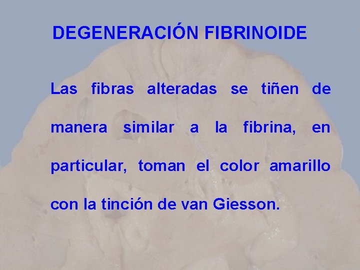 DEGENERACIÓN FIBRINOIDE Las fibras alteradas se tiñen de manera similar a la fibrina, en