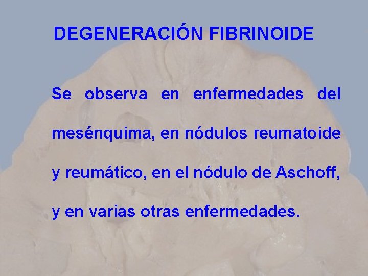 DEGENERACIÓN FIBRINOIDE Se observa en enfermedades del mesénquima, en nódulos reumatoide y reumático, en