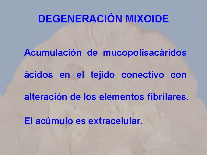 DEGENERACIÓN MIXOIDE Acumulación de mucopolisacáridos ácidos en el tejido conectivo con alteración de los