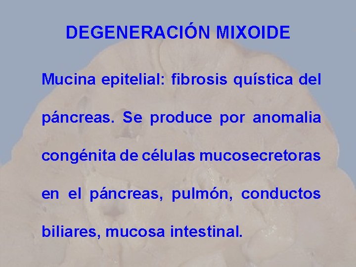 DEGENERACIÓN MIXOIDE Mucina epitelial: fibrosis quística del páncreas. Se produce por anomalia congénita de