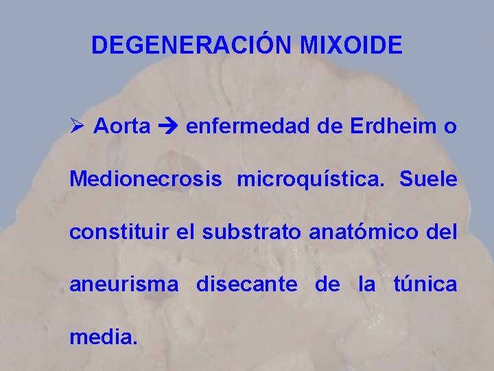 DEGENERACIÓN MIXOIDE Ø Aorta enfermedad de Erdheim o Medionecrosis microquística. Suele constituir el substrato