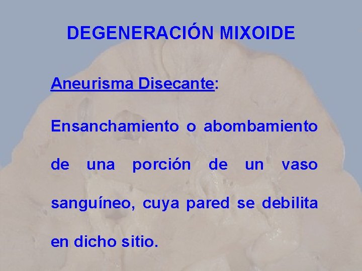 DEGENERACIÓN MIXOIDE Aneurisma Disecante: Disecante Ensanchamiento o abombamiento de una porción de un vaso