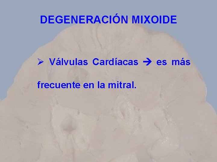 DEGENERACIÓN MIXOIDE Ø Válvulas Cardíacas es más frecuente en la mitral. 